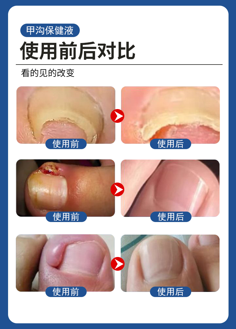 甲溝炎專用液有用嗎？使用前后對比